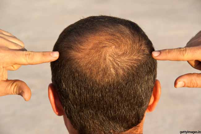 स्कैल्प पिगमेंटेशन कराना अच्छा विकल्प