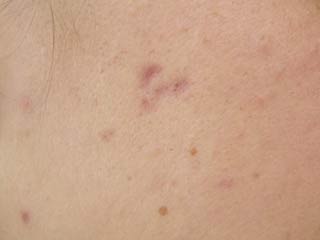 18 Percent of women in India are affected by PCOS