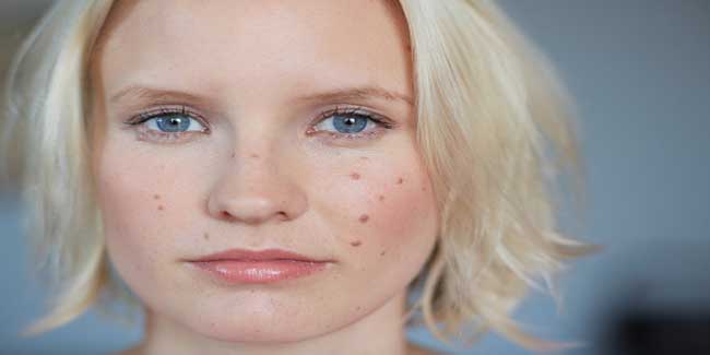 How to use lemon juice to stop zit redness?