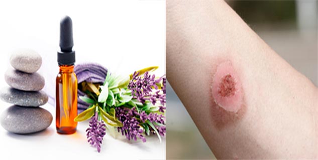 जलने के लिए लैवेंडर का तेल  lavender oil for burns in hindi