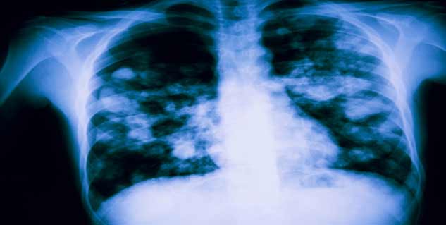 pulmonary-edema पल्मोनरी एडमा