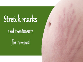 Stretch marks and treatments for removal