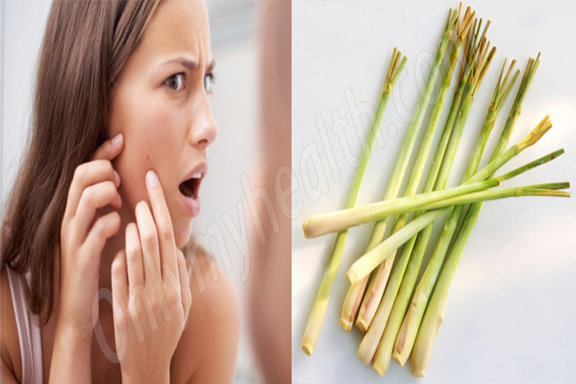 मुंहासों के लिए कैसे करे प्रयोग