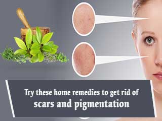 Try these home remedies to get rid of scars and pigmentation