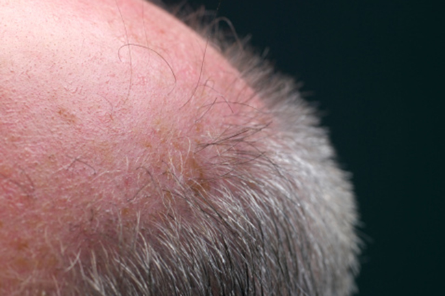 सोरायसिस (Psoriasis)