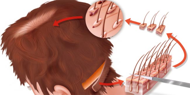 Follicular hair extraction technique for hair transplantation