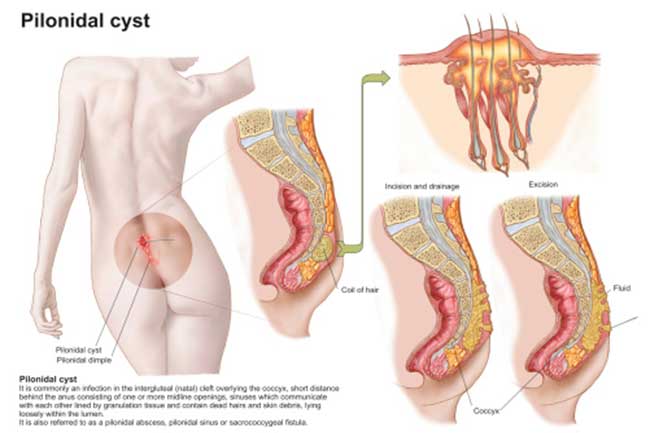पाइलोनाइडल सिस्ट्स और इसके घरेलू उपचार (Pilonidal Cyst)