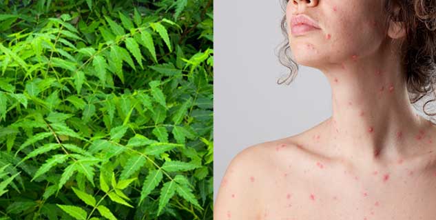 Medication for chickenpox in adults