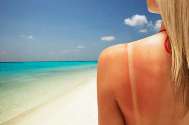 Help you get rid of sunburns
