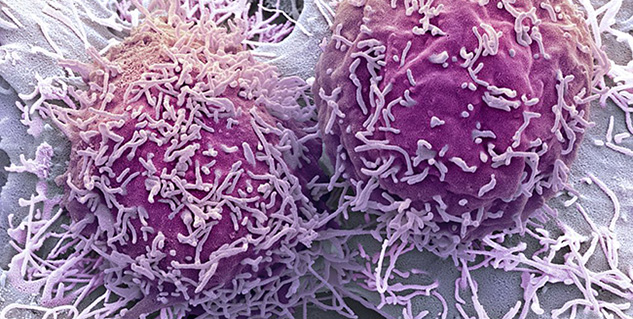 लिवर कैंसर Liver cancer In Hindi