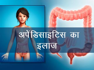 अपेंडिसाइटिस का इलाज