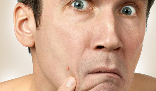 सिर्फ इस वजह से पुरुषों के चेहरे पर होते हैं मुहांसे