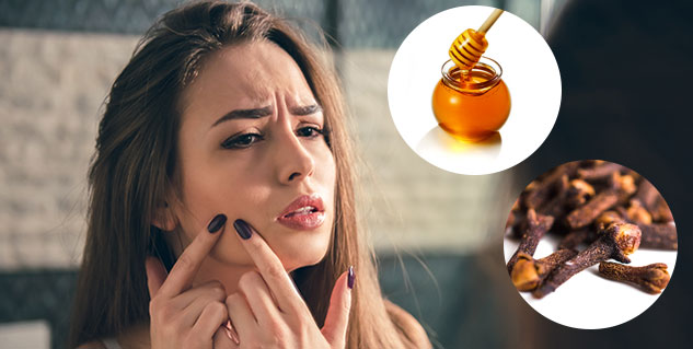 मुंहासों के दर्द और दाग को 1 ही रात में दूर करती लौंग
