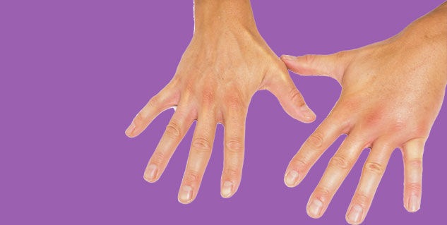 Causes And Treatments Of Swollen Hands In The Morning Swelling In Hand