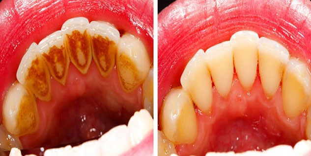 टार्टर tartar in hindi