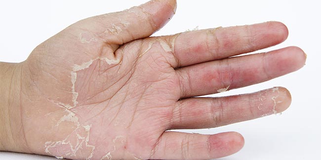 Skin Flaking Off Hands And Feet