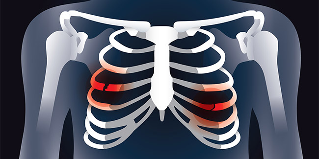 Costochondritis is a chest pain not a heart problem