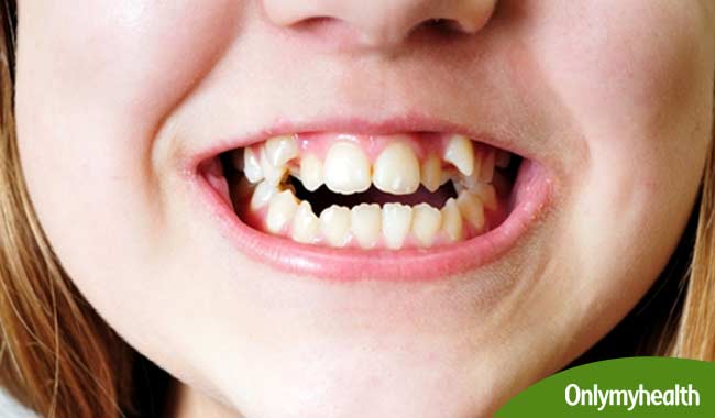 How Crooked Teeth Can Impact Your Dental and Overall Health