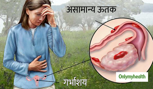 महिलाओं को क्यों होता है एंडोमेट्रियोसिस रोग, जानें कारण, लक्षण और उपचार