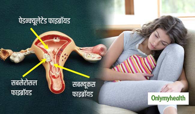 यूट्रस में फाइब्रॉयड के लक्षण हो सकते हैं अनियमित पीरियड्स और हेवी ब्लीडिंग, जानें बचाव