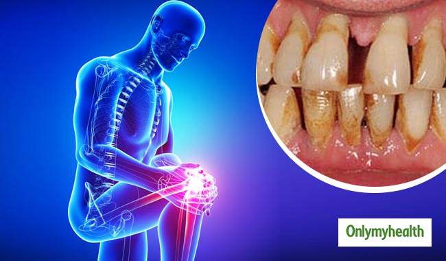 मुंह की गंदगी बन सकती है र्यूमेटॉइड अर्थराइटिस का कारण, जानें क्यों