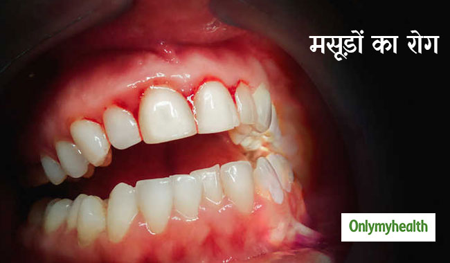 मसूड़ों का खतरनाक रोग है पेरिओडॉन्टाइटिस, कई अन्य बीमारियों के देता है जन्म