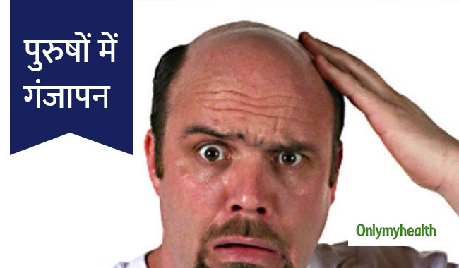 जानें क्यों सिर्फ पुरुषों में होती है गंजेपन की समस्या, कौन से हार्मोन हैं जिम्मेदार