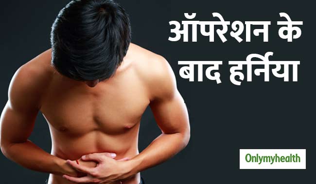 आॅपरेशन के बाद भी रहता है हर्निया रोगियों को खतरा, इन गलतियों को करने से बचें