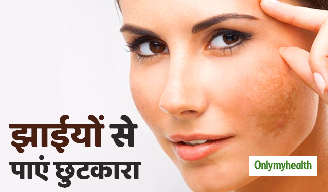 प्रेग्नेंसी में आई चेहरे की झाईयों को तुरंत दूर करता है ये उपाय, जानें अभी