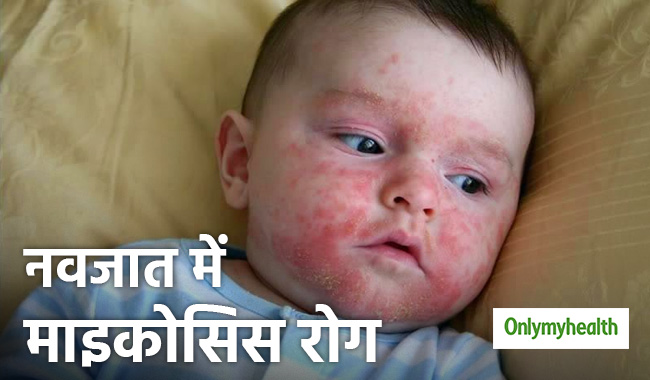 सर्दियों में आम है नवजात को माइकोसिस रोग होना, तुरंत जानें इसके शुरुआती लक्षण
