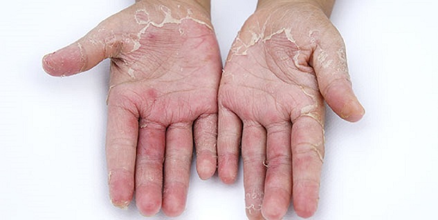 dry peeling skin on hands and feet