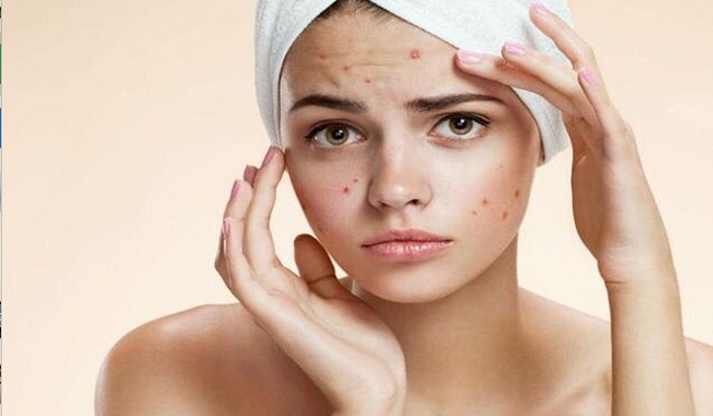 मुंहासों को 5 दिन में आसानी से ठीक करते हैं पान के पत्ते, जानें कैसे