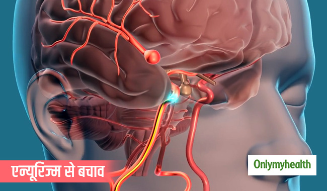 खतरनाक बीमारी है एन्यूरिज्म, जानें इसके लक्षण, कारण और बचाव