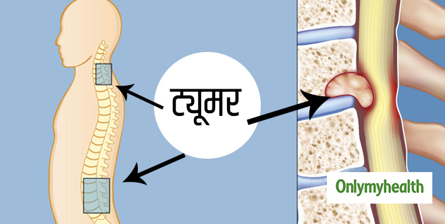 रीढ़ की हड्डी में ट्यूमर का कारण बन सकता है लगातार कुर्सी में बैठना
