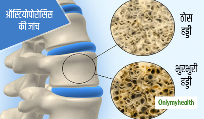 ऑस्टियोपोरोसिस के मरीजों के लिए जरूरी हैं ये 3 जांच, जानें खास बातें