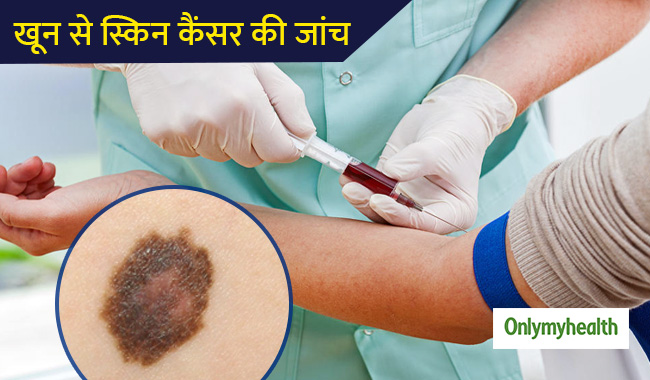 अब खून से हो सकेगी स्किन कैंसर की जांच, शुरुआत में ही चल जाएगा पता