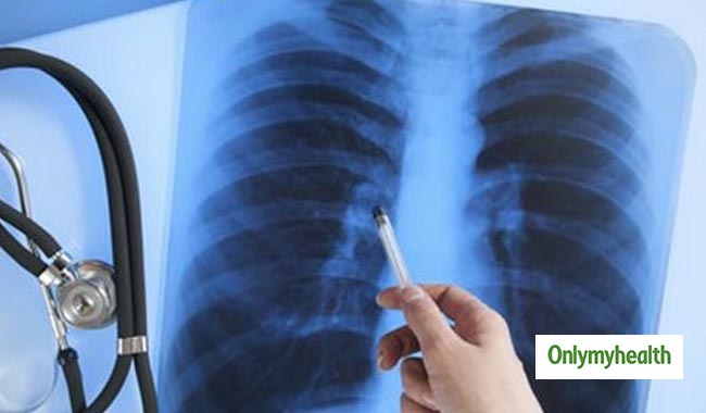 How long does Carcinoid Tumours of the Lung last?