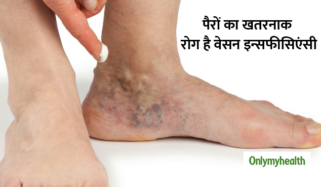 पैरों में संक्रमण का कारण हो सकता है वेनस इन्सफीसिएंसी, जानें खतरे