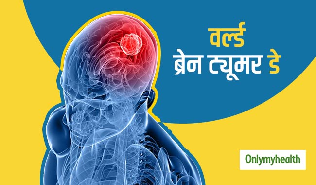 ब्रेन ट्यूमर क्या है? एक्सपर्ट से जानें इसके कारण, लक्षण और उपचार