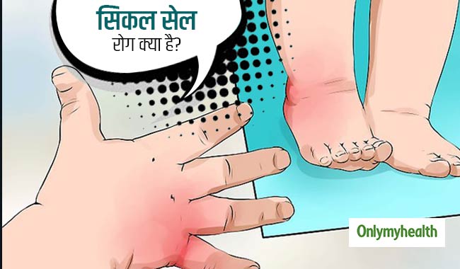 आनुवांशिक कारणों से होता है सिकल सेल रोग, जानें बचाव का तरीका