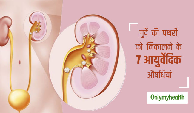 गुर्दे की पथरी को तोड़कर बाहर निकाल देती हैं ये 7 आयुर्वेदिक औषधियां