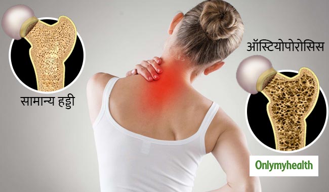 आखिर महिलाओं को क्यों होती है ऑस्टियोपोरोसिस की अधिक समस्या, जानें पूरा सच
