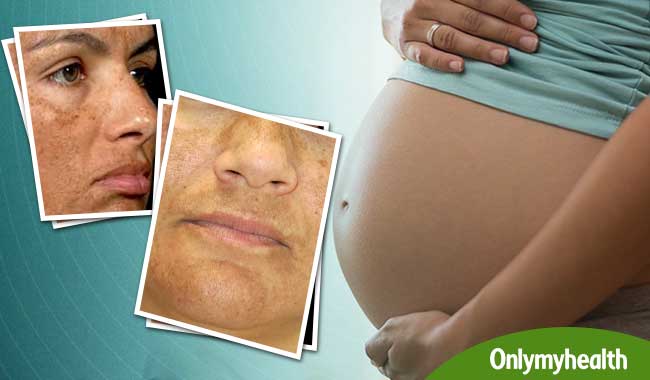 प्रेग्नेंसी में मेलास्मो की समस्या से बचाएंगी ये 5 टिप्स, आएगा ग्लो