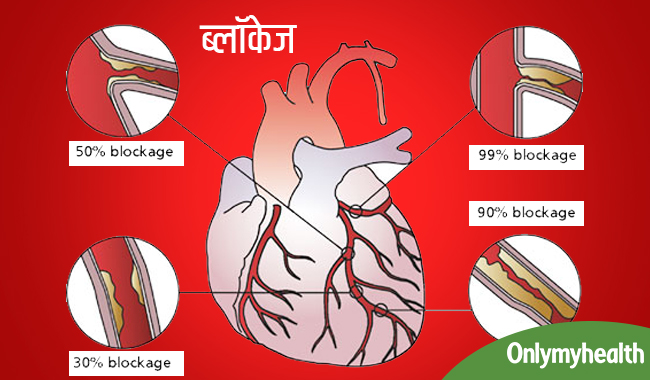 सीने में ऐसा दर्द है आटर्री में ब्लॉकेज का संकेत, तुरंत जानें लक्षण और इलाज