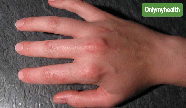 उंगलियों में सूजन की है ये 4 वजह, जानें इसके आयुर्वेदिक उपचार