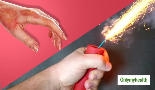 पटाखों से जल जाने पर न करें ये 5 गलतियां, आसान हैं घरेलू उपचार
