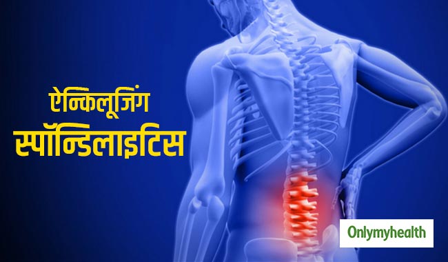 युवाओं के लिए खतरनाक रोग है ऐन्किलूजिंग स्पॉन्डिलाइटिस, पीठ में दर्द है मुख्य लक्षण