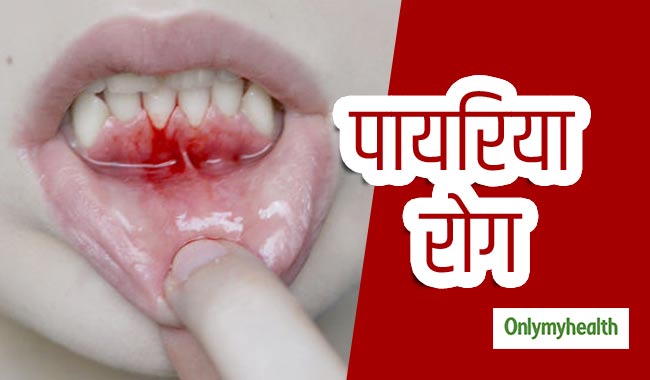 पायरिया रोग के लक्षण हैं दांतों और मसूड़ों से खून आना, जानें बचाव का तरीका