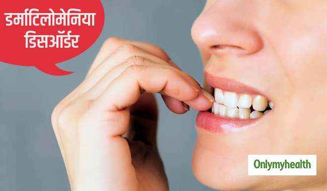 दांतों से स्किन को नोचना है डर्माटिलोमेनिया डिस्आॅर्डर, जानें कितना नुकसादायक है ये