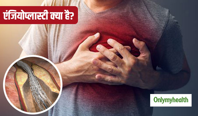 धमनियों की बीमारियों में वरदान है एंजियोप्लास्टी, एक्सपर्ट से जानें क्या है ये तकनीक